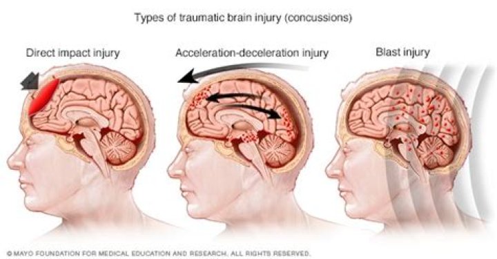 Are injuries that cause brain damage permanent?