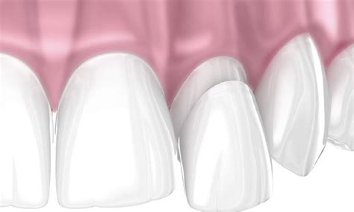 Are peg laterals covered by insurance?