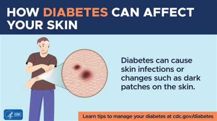 Can a diabetic be in the military?