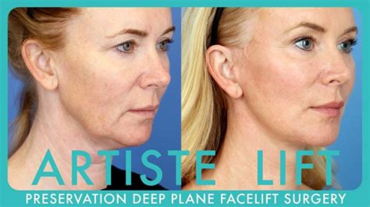 Can a facelift be covered by insurance?