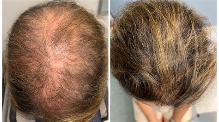 Can a trichologist stop hair loss?