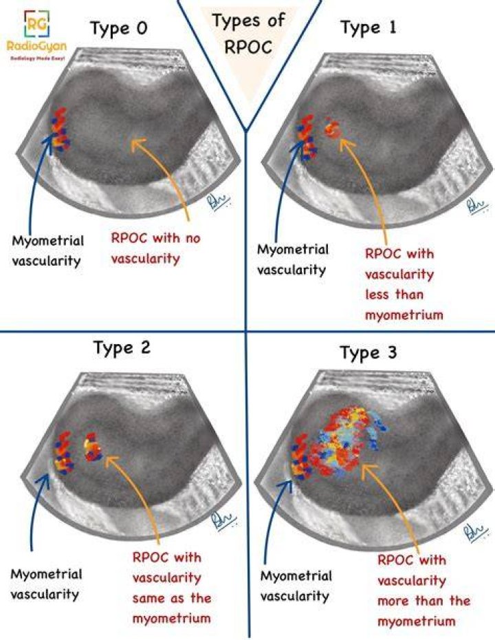Can you get pregnant with retained products of conception?