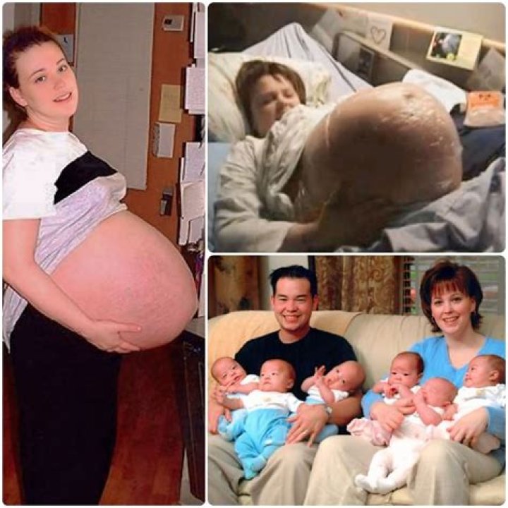 Did Kate Gosselin give birth naturally?