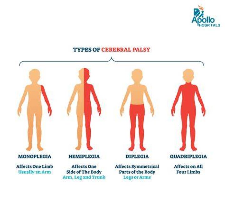 Does cerebral palsy qualify for SSDI?