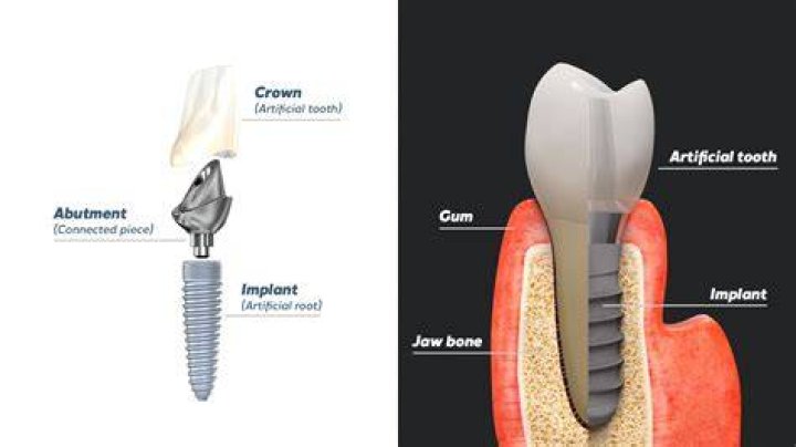 How do you prove dental implants are medically necessary?