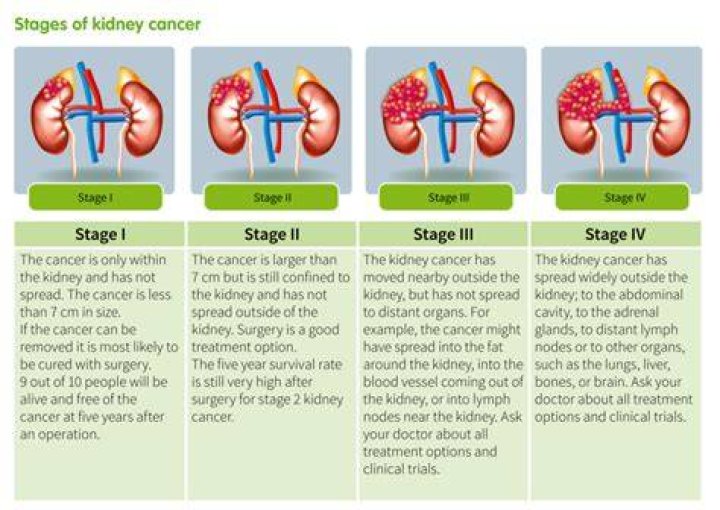 How long can you live with Stage 4 renal cancer?