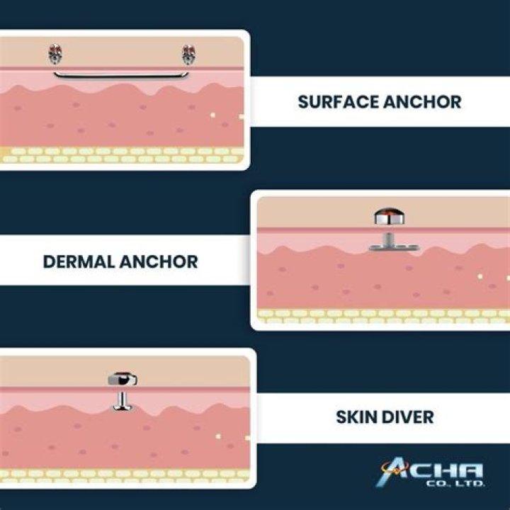 How much does a dermal anchor cost?