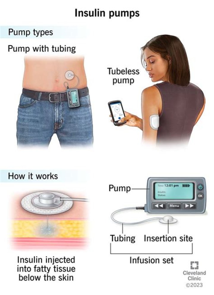 How much does Medtronic insulin pump cost?