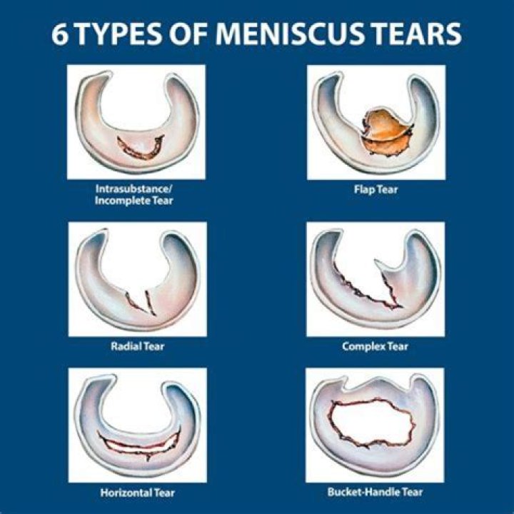 How much is a meniscus tear settlement worth?