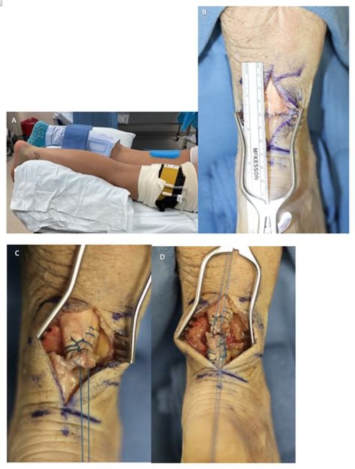 How much is Achilles tendon surgery?
