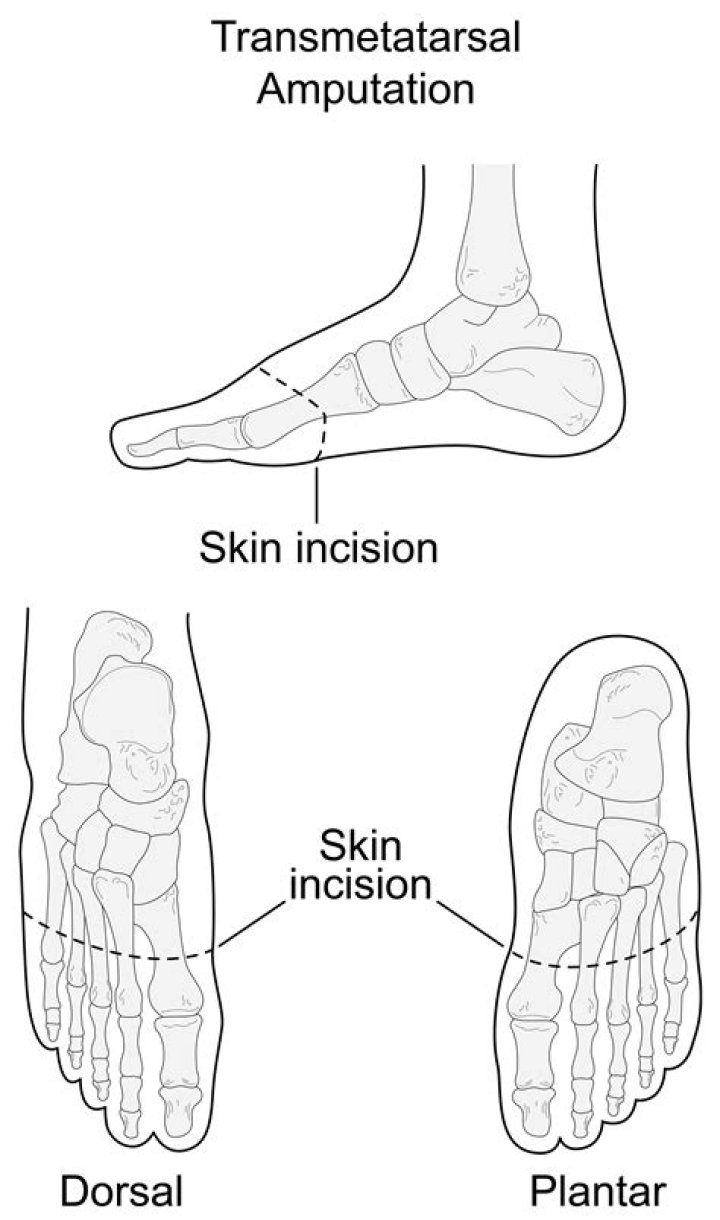 How much is an amputated toe worth?
