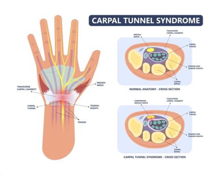 Is carpal tunnel a disability in California?