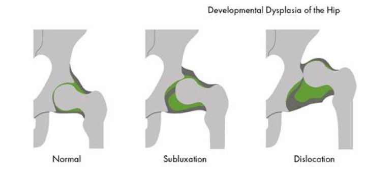 Is hip dysplasia considered a pre-existing condition?