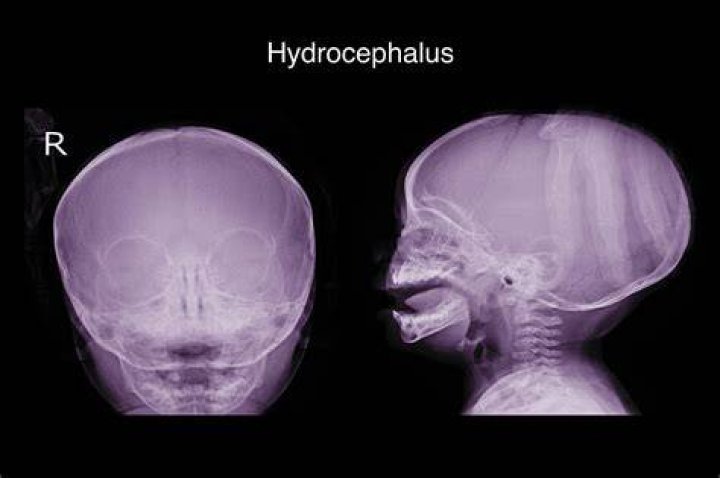 Is hydrocephalus considered a birth defect?