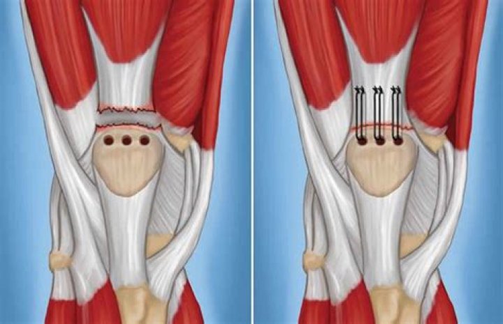 What does a partial quad tear feel like?