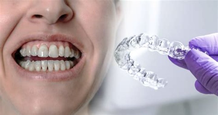 What is the cheapest way to get Invisalign?