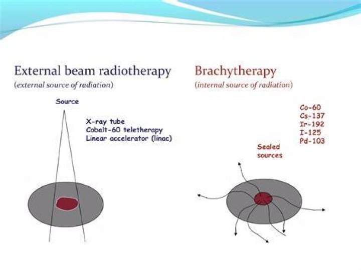 What radioactive material is used in brachytherapy?